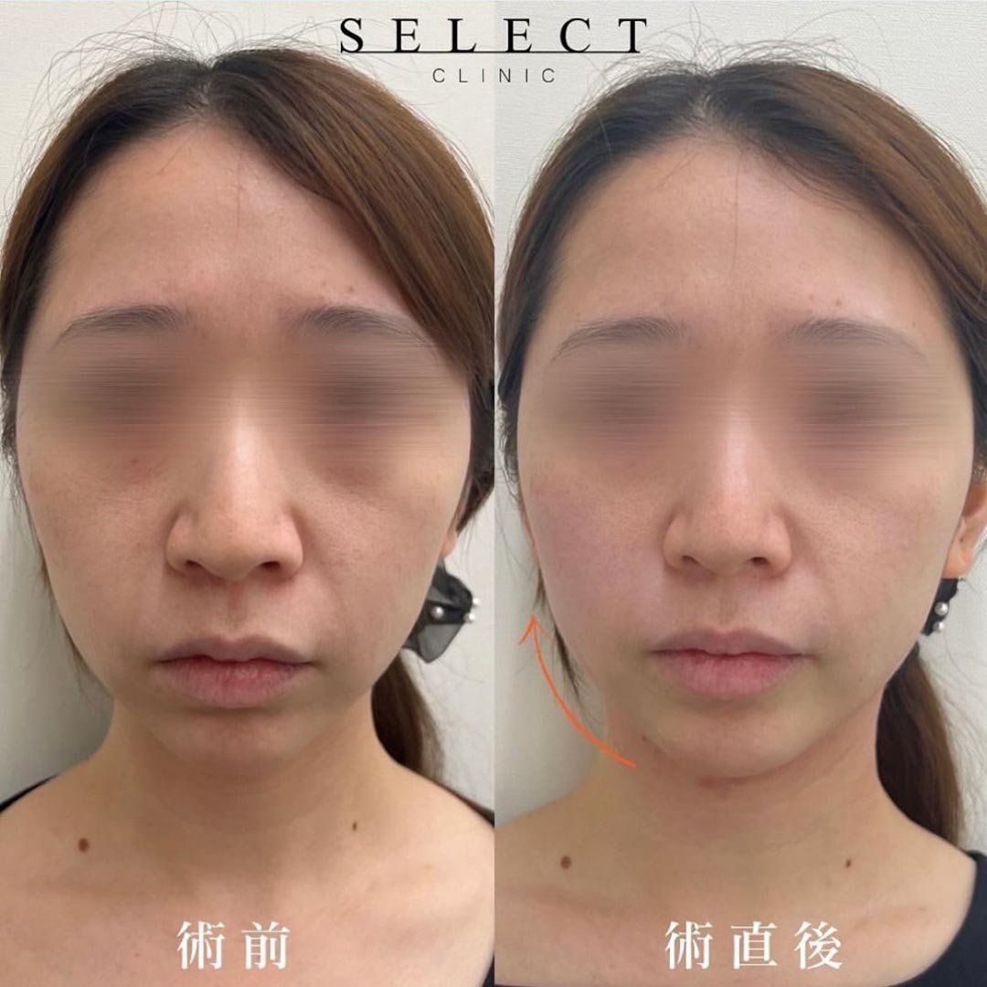 非手術、低侵襲　美容外科 貴族部位 ヒアルロン酸注入💉症例写真】 ⁡ 📸: 術前・術後